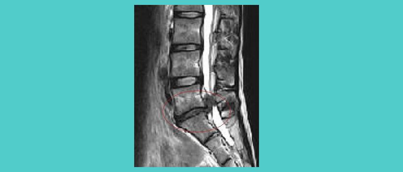 250-3腰椎椎間板ヘルニア