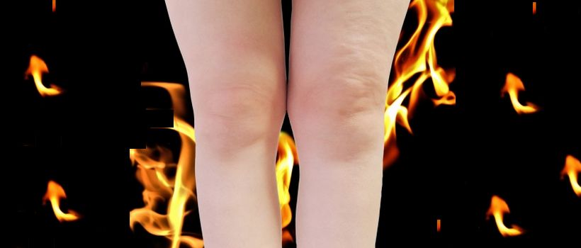 280-1膝関節水腫