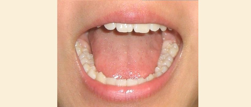 309-2ドライマウス