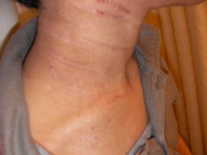 アトピー性皮膚炎2